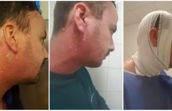 Un kabyle attaqué à l’acide par des algériens lors d’une manifestation à Paris