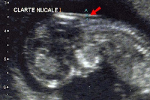 Tuviret : des spécialistes plaident une prise en charge précoce de l'enfant atteint de trisomie 21 Tuviret : des spécialistes plaident une prise en charge précoce de l'enfant atteint de trisomie 21